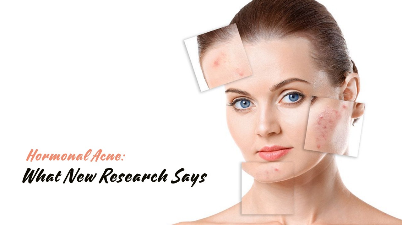 Hormonal Acne: What New Research Says