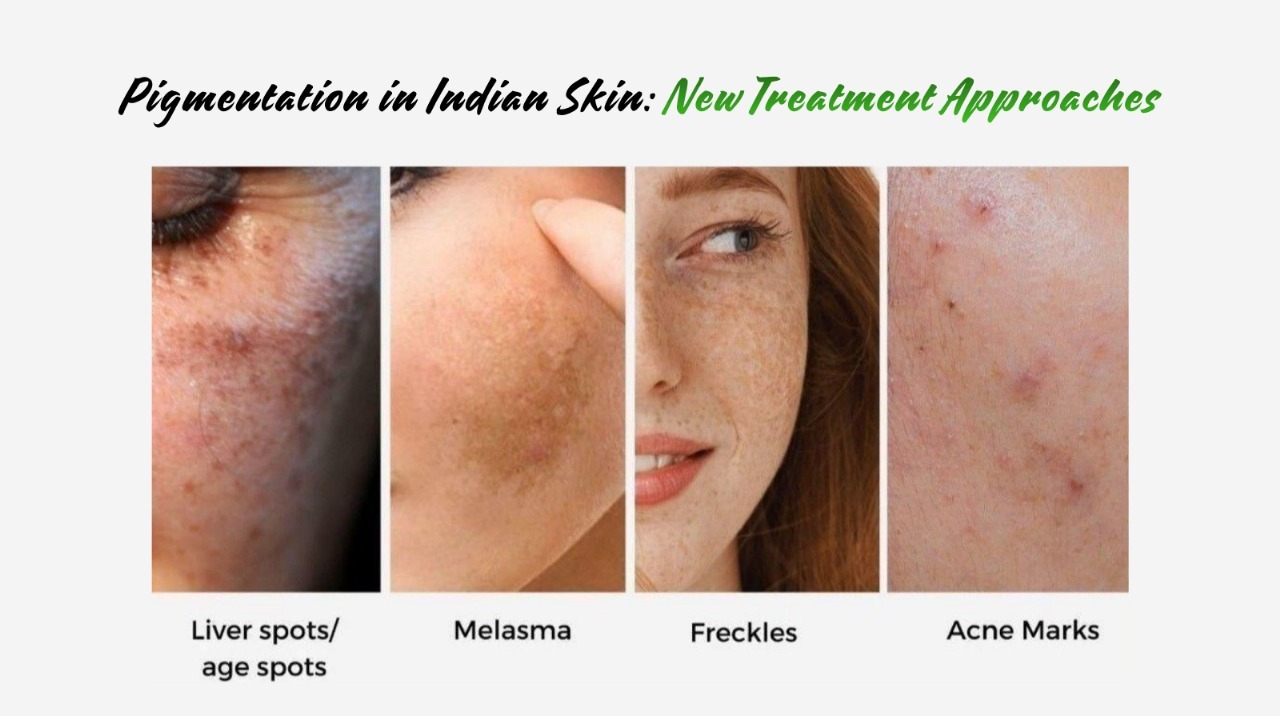 Pigmentation in Indian Skin: New Treatment Approaches for 2026